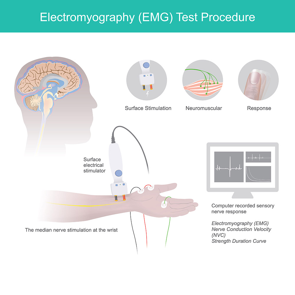 A dragram displaying the equipment used in an EMG test and the steps for completing the test on a human subject.