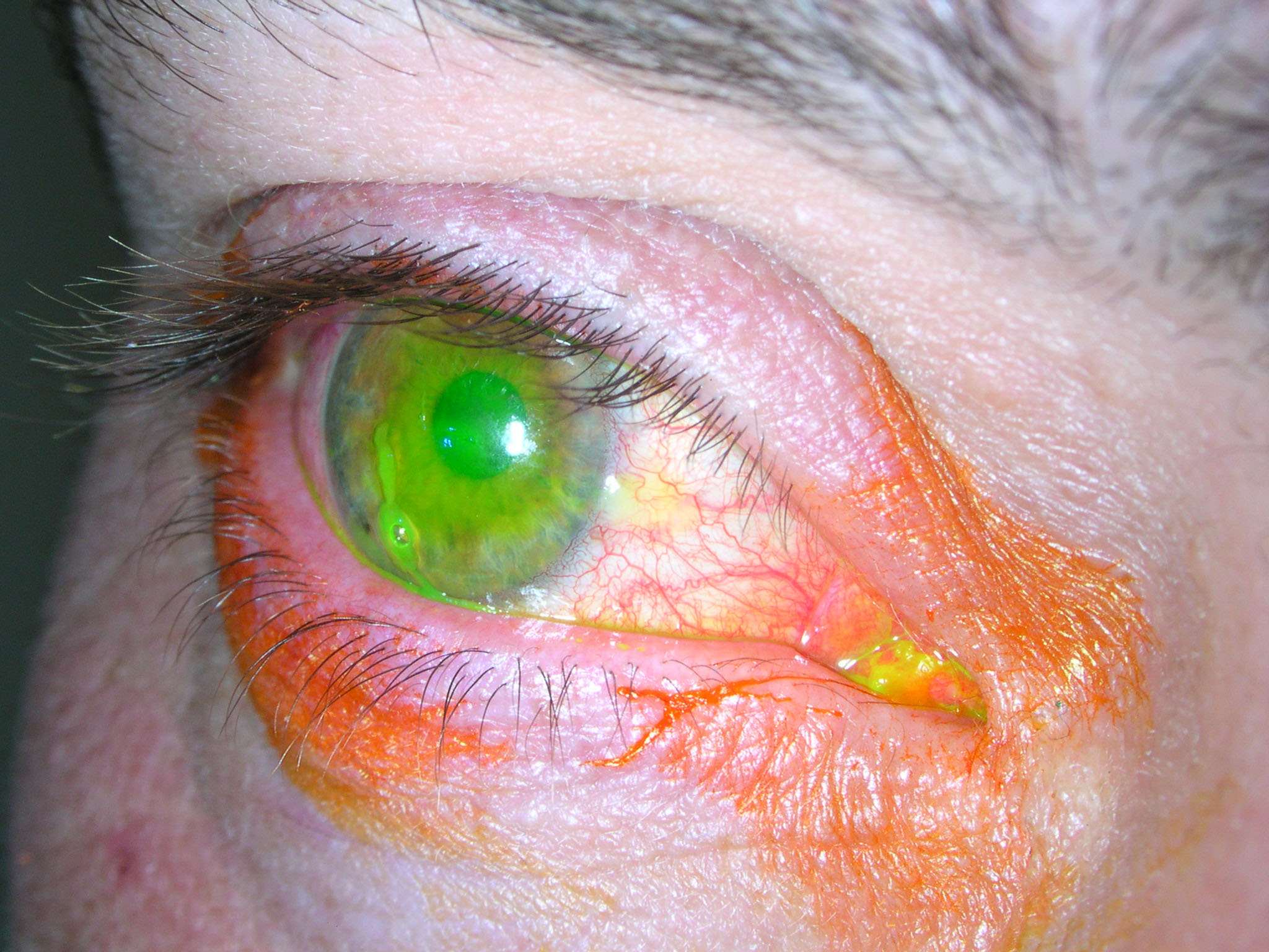 Staining to detect corneal injury